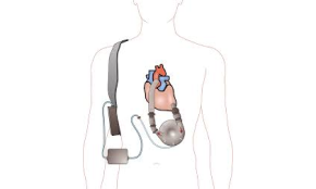 VENTRICULAR ASSIST DEVICE (VAD)